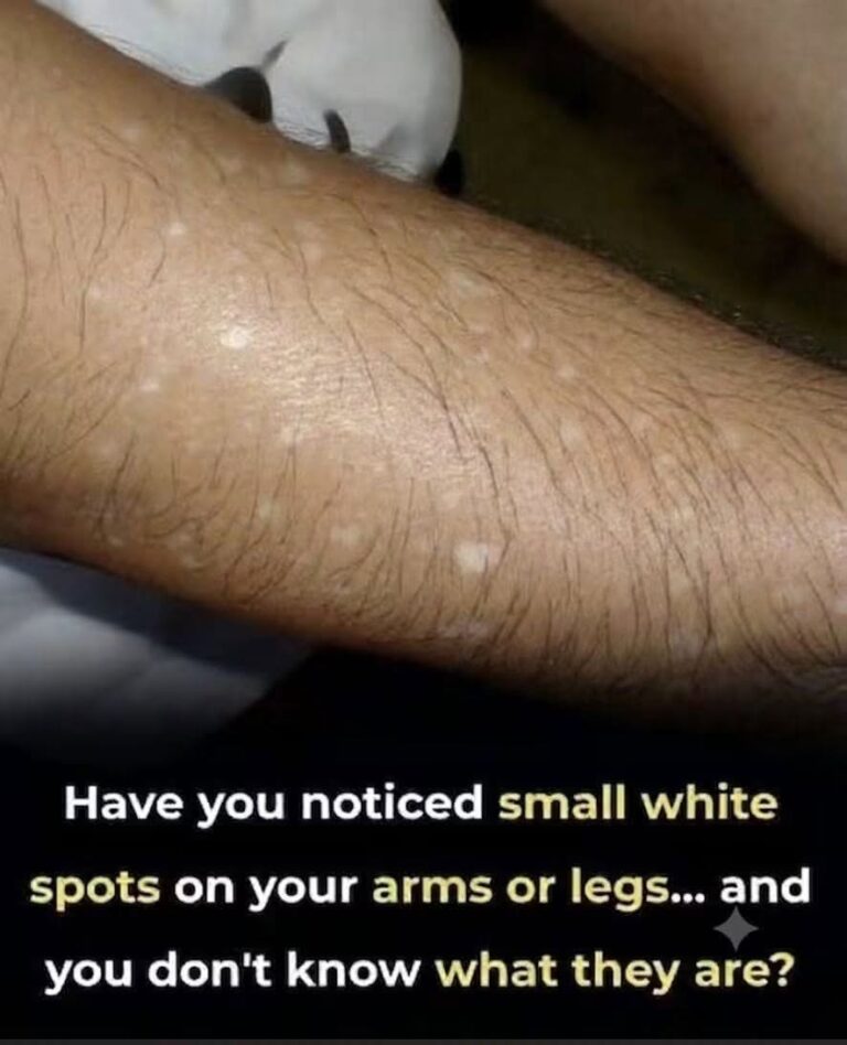 Have You Noticed Small White Spots on Your Arms or Legs? Here’s What They Are1
